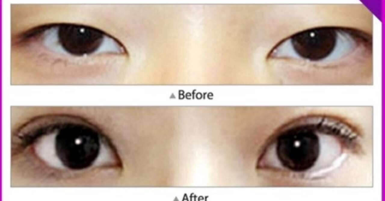 割<a href=http://www.f3bb6.cn/listinfo-724-0.html target=_blank class=infotextkey>雙眼皮</a>術后如何護理