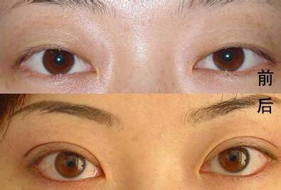 吸雕<a href=http://www.f3bb6.cn/listinfo-724-0.html target=_blank class=infotextkey>雙眼皮</a>手術的原理