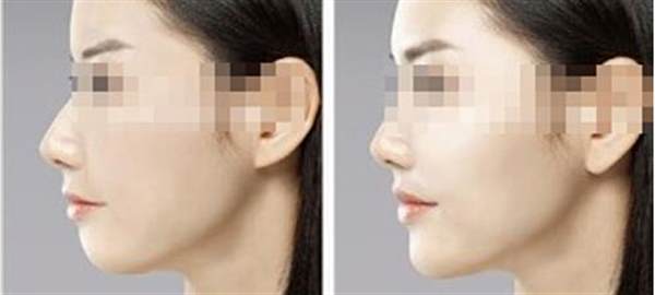 取下巴假體的經歷圖