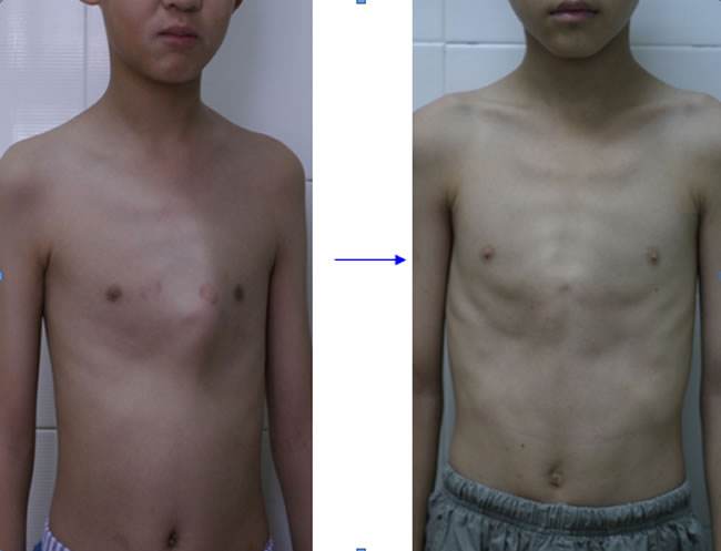 胸肌不對稱矯正方法