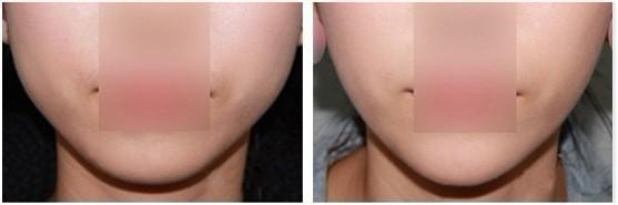 經期打<a href=http://www.f3bb6.cn/listinfo-631-0.html target=_blank class=infotextkey>瘦臉</a><a href=http://www.f3bb6.cn/listinfo-614-0.html target=_blank class=infotextkey>除皺</a>了該咋辦