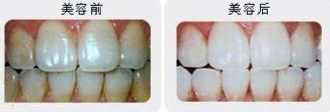 牙齒變黃原因及具體改善方法