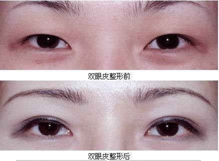 割<a href=http://www.f3bb6.cn/listinfo-724-0.html target=_blank class=infotextkey>雙眼皮</a>抽脂疼嗎