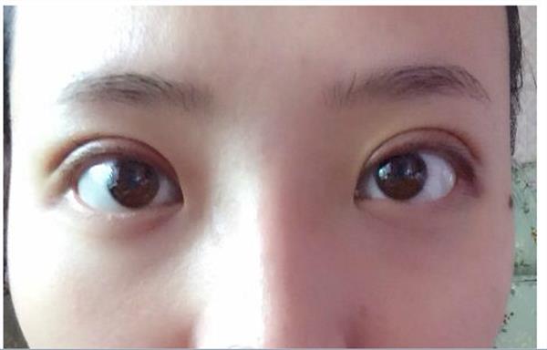 埋線<a href=http://www.f3bb6.cn/listinfo-724-0.html target=_blank class=infotextkey>雙眼皮</a>前列天照片