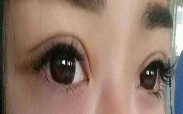 多層褶皺<a href=http://www.f3bb6.cn/listinfo-724-0.html target=_blank class=infotextkey>雙眼皮</a>怎么辦