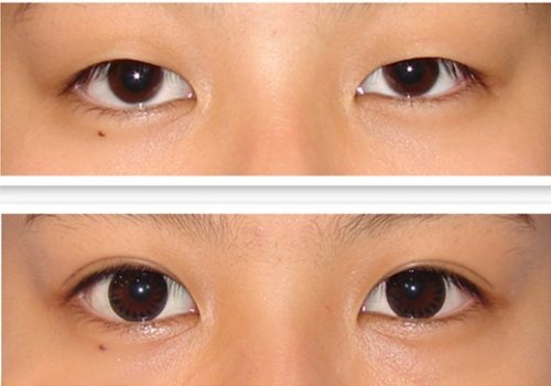 埋線法<a href=http://www.f3bb6.cn/listinfo-724-0.html target=_blank class=infotextkey>雙眼皮</a>術前的注意事項