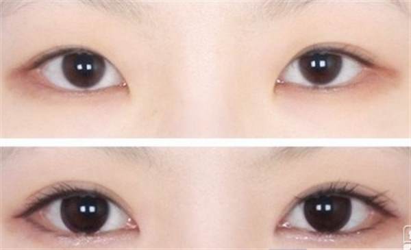 埋線<a href=http://www.f3bb6.cn/listinfo-724-0.html target=_blank class=infotextkey>雙眼皮</a>的效果可以維持多久