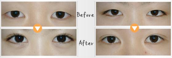 割<a href=http://www.f3bb6.cn/listinfo-724-0.html target=_blank class=infotextkey>雙眼皮</a>幾天能拆線