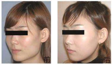 做<a href=http://www.f3bb6.cn/listinfo-629-0.html target=_blank class=infotextkey>下頜角</a>整形手術(shù)術(shù)后注意哪些呢