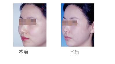 下頜骨不對稱自我矯正