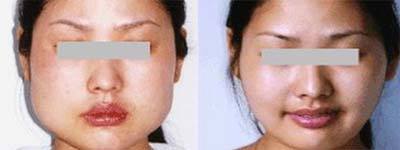 下頜骨手術(shù)后恢復(fù)