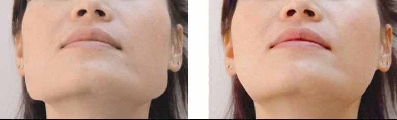 下<a href=http://www.f3bb6.cn/listinfo-644-0.html target=_blank class=infotextkey>頜骨整形</a>多久能恢復(fù)