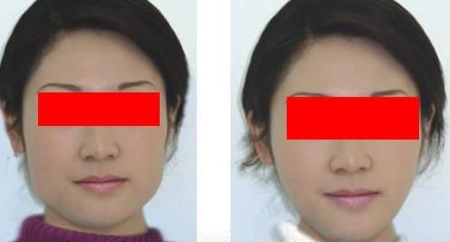 去除雙下巴多少錢