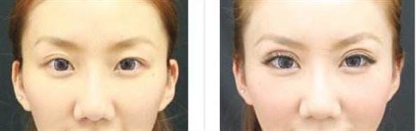 上眼皮抽脂前后對比案例圖