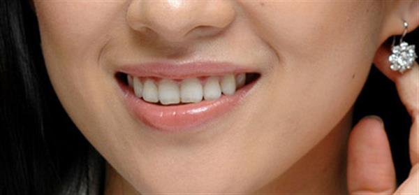 隆下巴后能正常吃饭吗