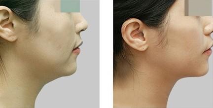 頜骨<a href=http://www.f3bb6.cn/listinfo-10-0.html target=_blank class=infotextkey>整形價格</a>