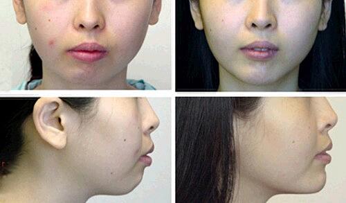 硅膠墊下巴多少錢