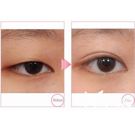 沈陽<a href=http://www.f3bb6.cn/listinfo-724-0.html target=_blank class=infotextkey>雙眼皮</a>手術價格