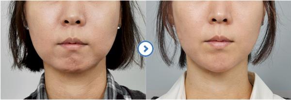 做自體脂肪豐下巴手術有哪些特點呢