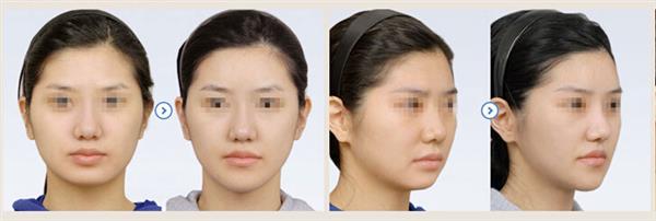 做膨體隆下巴手術價格是多少