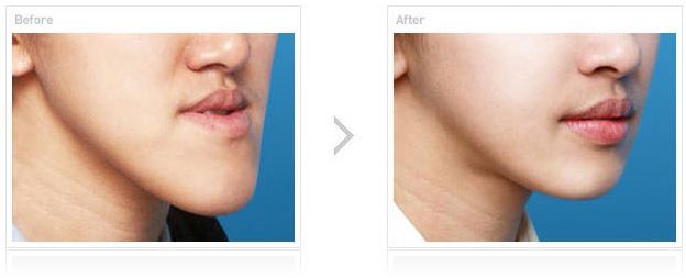 小孩地包天怎么矯正