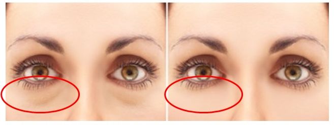 女人眼袋大怎么解決