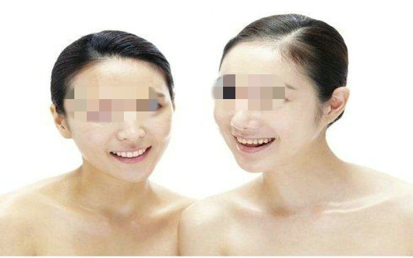 假体<a href=http://www.f3bb6.cn/listinfo-737-0.html target=_blank class=infotextkey>隆鼻</a>多久能恢复