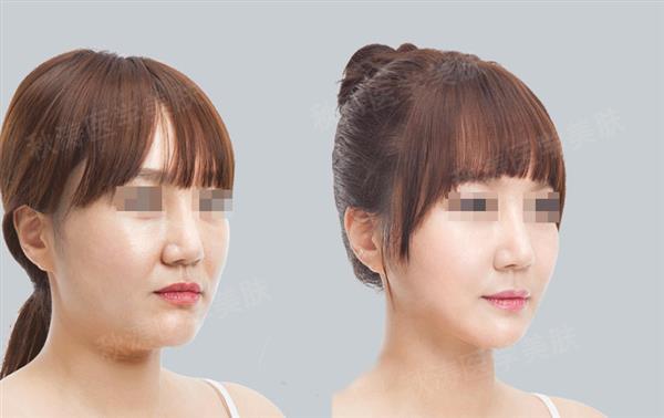 打完<a href=http://www.f3bb6.cn/listinfo-631-0.html target=_blank class=infotextkey>瘦臉</a><a href=http://www.f3bb6.cn/listinfo-614-0.html target=_blank class=infotextkey>除皺</a>多久吃飯