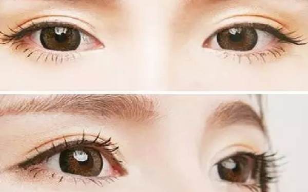 韓式多點定位多久消腫