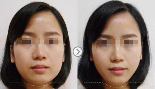 <a href=http://www.f3bb6.cn/listinfo-631-0.html target=_blank class=infotextkey>瘦臉</a><a href=http://www.f3bb6.cn/listinfo-614-0.html target=_blank class=infotextkey>除皺</a>有什么后遺癥