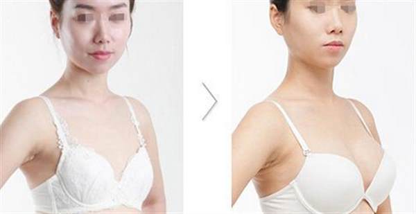 豐胸打針效果怎么樣