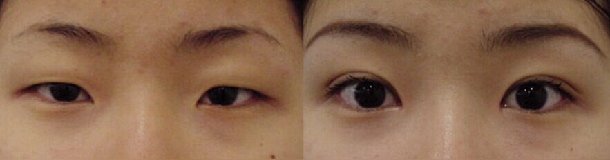 <a href=http://www.f3bb6.cn/listinfo-711-0.html target=_blank class=infotextkey>開眼角</a>失敗術(shù)后怎么修復(fù)