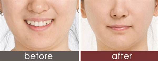 雙下巴整容哪里好