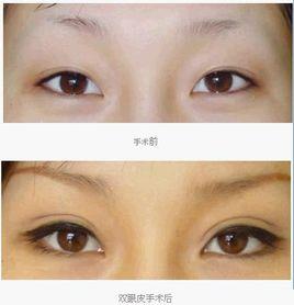 三點定位是可以拆掉的