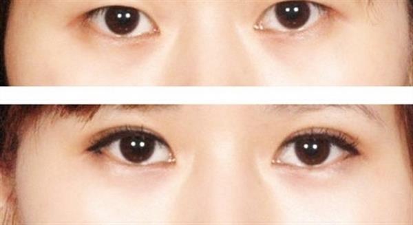 <a href=http://www.f3bb6.cn/listinfo-724-0.html target=_blank class=infotextkey>雙眼皮</a>7mm一年后照片效果對比