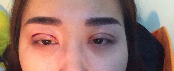 割了<a href=http://www.f3bb6.cn/listinfo-724-0.html target=_blank class=infotextkey>雙眼皮</a>喝酒會怎樣