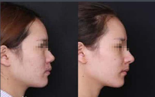 硅膠假體<a href=http://www.f3bb6.cn/listinfo-737-0.html target=_blank class=infotextkey>隆鼻</a>好嗎