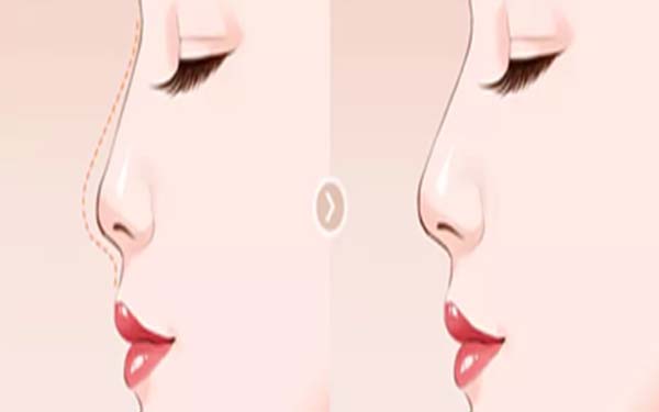 硅膠假體<a href=http://www.f3bb6.cn/listinfo-737-0.html target=_blank class=infotextkey>隆鼻</a>后鼻子會透光嗎