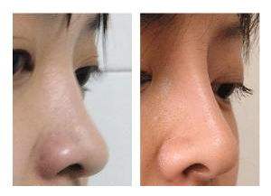 做假體鼻子恢復過程
