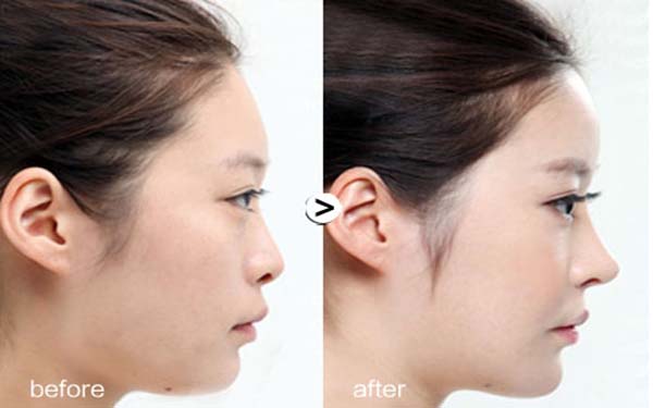 硅膠假體<a href=http://www.f3bb6.cn/listinfo-737-0.html target=_blank class=infotextkey>隆鼻</a>優勢及效果