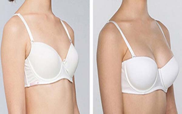 硅膠假體<a href=http://www.f3bb6.cn/listinfo-618-0.html target=_blank class=infotextkey>隆胸</a>多少錢？