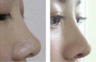 鼻頭太大怎么變小