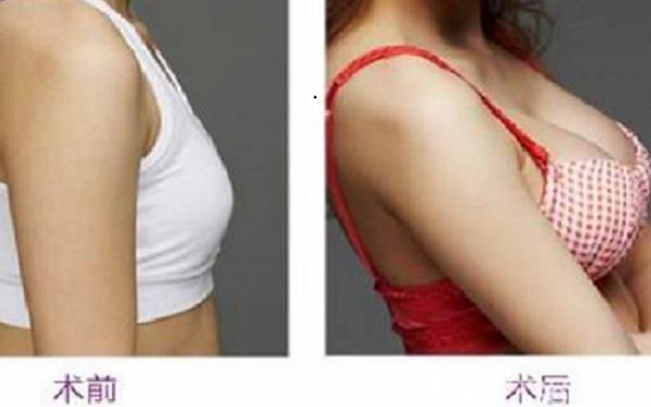 自體脂肪豐胸術后有哪些注意事項