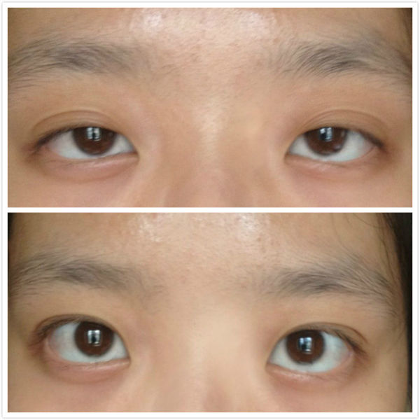 眼瞼下垂矯正術的手術方法