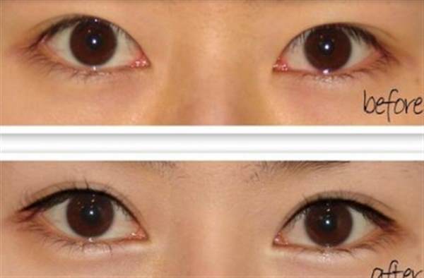 <a href=http://www.f3bb6.cn/listinfo-711-0.html target=_blank class=infotextkey>開眼角</a>大概多少錢？