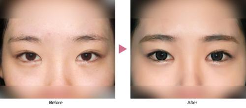 什么眼睛适合开外眼角